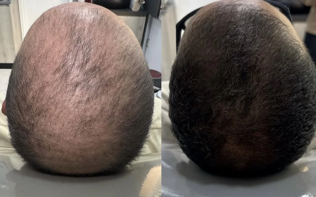 Registro comparativo do vértice do couro cabeludo, antes e depois do período de acompanhamento
