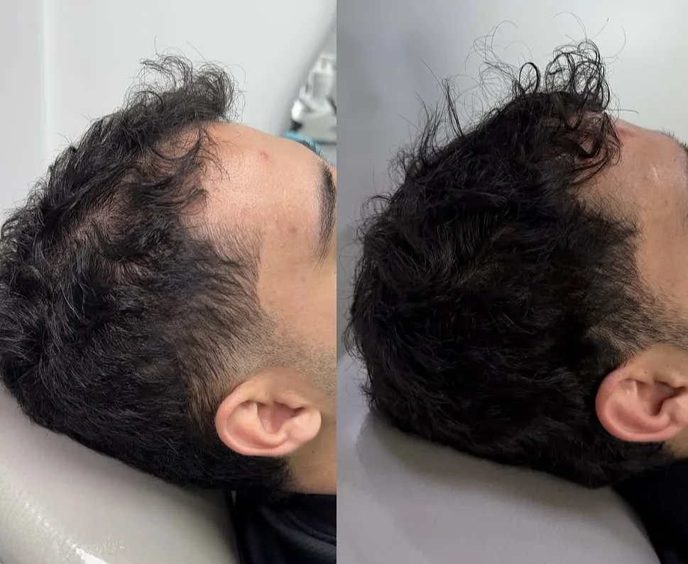 Registro comparativo da região frontal e temporal, antes e depois do período de acompanhamento